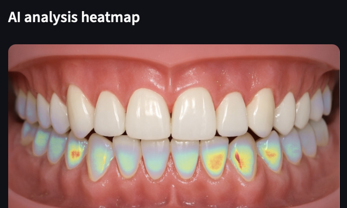 Grad-CAM heatmap over a photo of teeth, with red and yellow on the lower front teeth